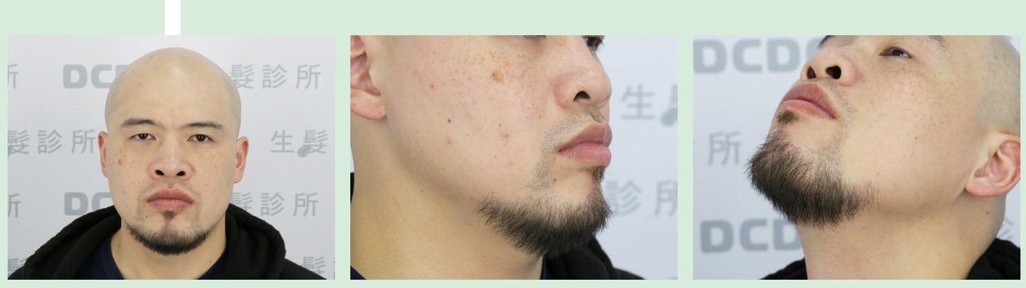 FUE術後9個月就看到明顯改變